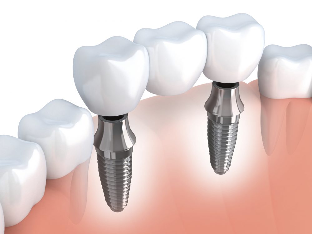 Les implants dentaires de qualité à la clinique dentaire Fréchette et Nadeau de Victoriaville.